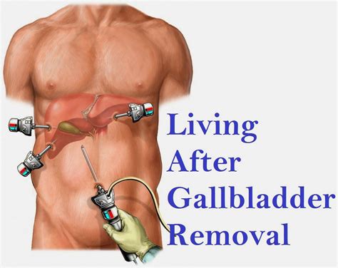 Living After Gallbladder Removal | Gallbladder, How to remove, Healthy ...