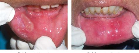 Figure 3 from Recurrent Aphthous Stomatitis: Current Concepts in ...