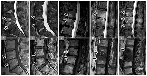 JCM | Free Full-Text | Vertebral Bone Marrow and Endplate Assessment on MR Imaging for the ...