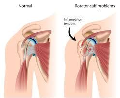 Swimmers Shoulder | MGS Physiotherapy