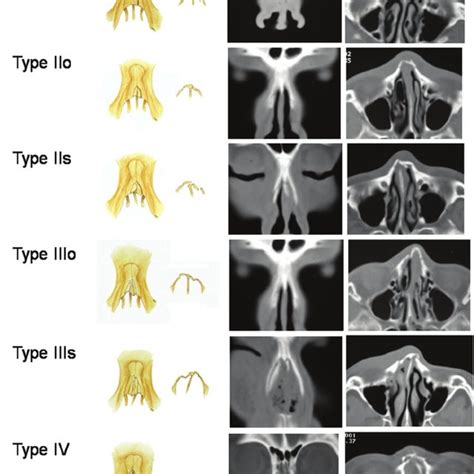 Classification of nasal bone fracture. | Download Scientific Diagram