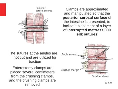 Lt hemicolectomy - Surgical Approach, Complications.