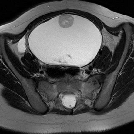 Ovarian Dermoid Cyst