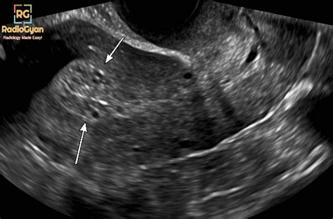 Tamoxifen-associated Endometrial Changes Ultrasound - RadioGyan