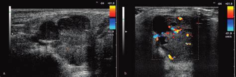 Color Doppler ultrasound – pleomorphic adenoma; a) Typical hypovascular ...