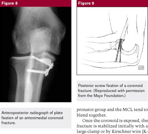 Figure 8 from Coronoid process fracture. - Semantic Scholar