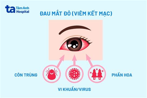 4 cách chữa đau mắt đỏ tại nhà hiệu quả, trị hết đau nhanh chóng