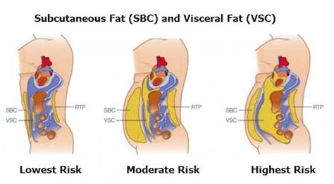 Health Risks of Visceral Fat