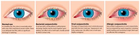 Natural Remedies for Pink Eye - The Prepared Page