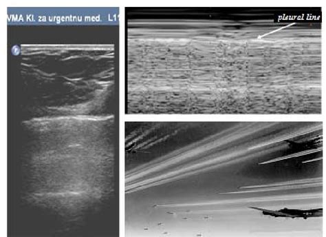 Pneumothorax diagnosed by ultrasound the twodimensional image on the... | Download Scientific ...