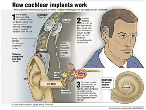 Cochlear implants give the gift of hearing, but they’re not for ...