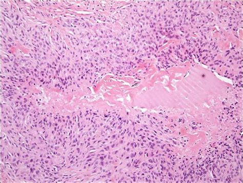 Epithelioid Sarcoma - Pathology - Orthobullets