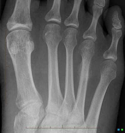 Stress Fracture X Ray Tibia