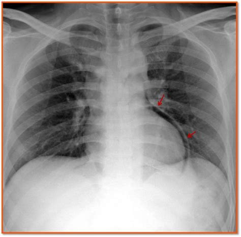 Pneumopericardium | Radiology imaging, Radiology, Medical imaging