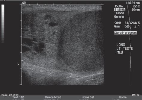 Figure 2 from Testicular Tumor Ultrasound Characteristics and Association with Histopathology ...