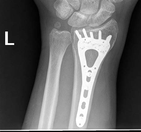 Fractures & Dislocations - George S.M. Dyer, MD