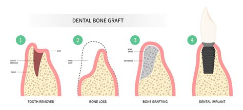 Dental Bone Grafts in Plymouth | Bone grafting procedure in Mannamead, Plympton, Saltash and ...