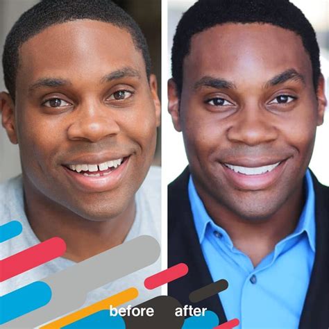 Invisalign Before and After PicturesDr. Jacquie