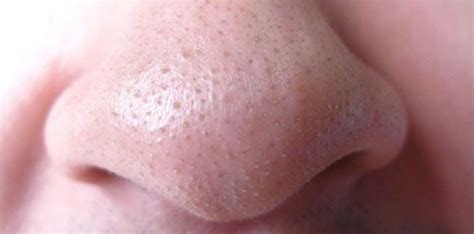 Clogged Nose Pores: Causes, Cleaning and Clearing - Skincarederm