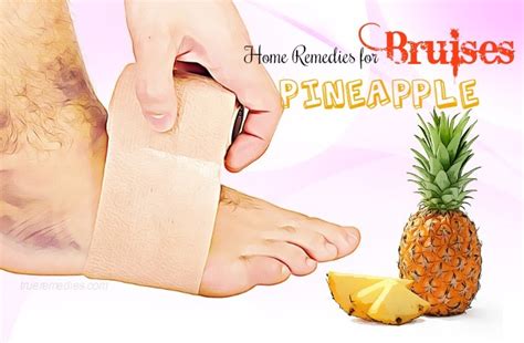 13 Home Remedies For Bruises On Face, Arms & Legs