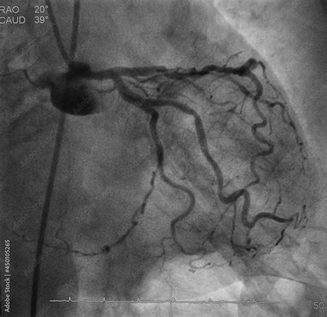 Coronary artery angiogram (CAG) of left coronary artery stenosis Stock Photo | Adobe Stock