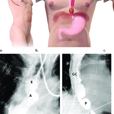 (PDF) Esophagectomy and Gastric Pull-through Procedures: Surgical Techniques, Imaging Features ...