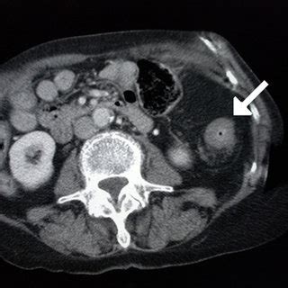 Abdominal Ct showing an apple-core lesion of the transverse colon... | Download Scientific Diagram