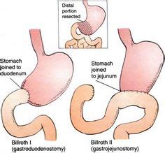 biliroth 1: gastroduodenostomy biliroth 2: gastrojejunostomy | studying to be a doctor