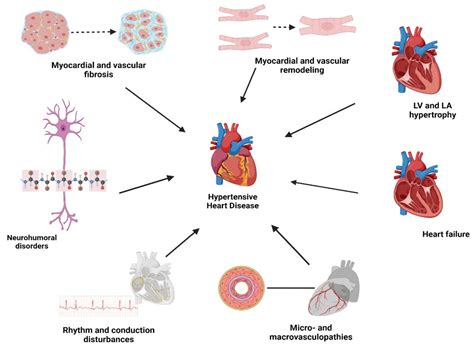 JCM | Free Full-Text | Hypertensive Heart Disease: A Narrative Review ...