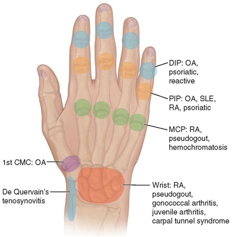 Sites of hand or wrist involvement and their potential disease associations. (DIP, distal ...