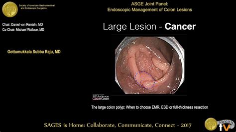 Large Colon Polyps