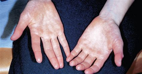 Acrocyanosis ICD-10, Definition, Pictures, Symptoms, Causes, Treatment - Health Care Tips and ...