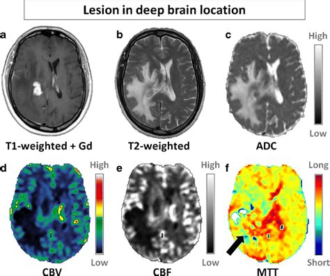 Patient with a PCNSL in a deep brain location. Representative... | Download Scientific Diagram