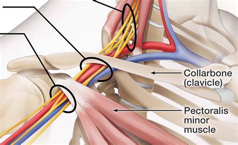 thoracic-outlet-syndrome - Living Metta