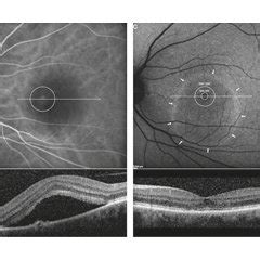 Diagnostic and therapeutic protocol of a left eye with acute CSCR. (a)... | Download Scientific ...