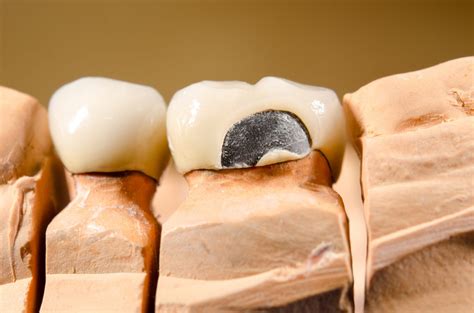 Crowns & Bridges – Wisdom Dental Surgery