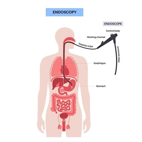 Premium Vector | Gastroscopy procedure Gastroenterologist uses a ...