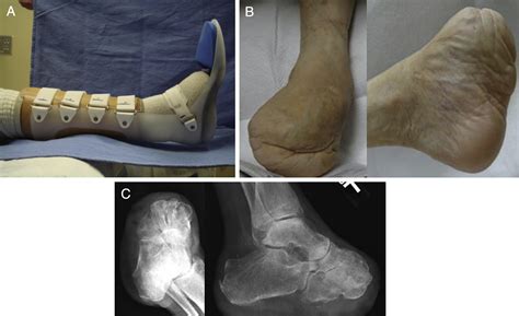 Medial and Lateral Plantar Artery Angiosome Rotational Flaps for ...