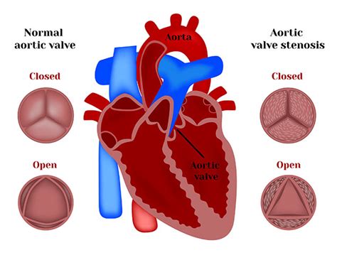 Aortic Stenosis | Cardiovascular Institute of The Shoals | Florence, AL