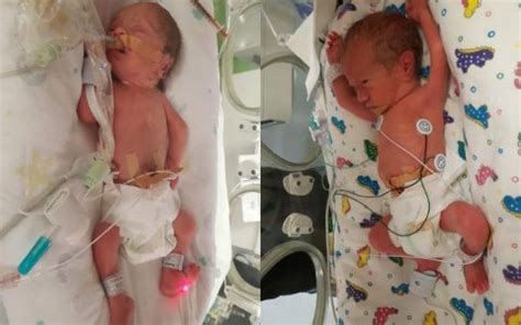 Triplets (With Surviving Fraternal Boy Twins) Born at 29+4