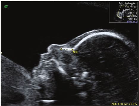 Nasal Bone Ultrasound