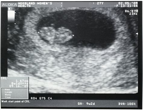 File:Ultrasound of human fetus, 8 weeks and 1 day.jpg - Wikipedia