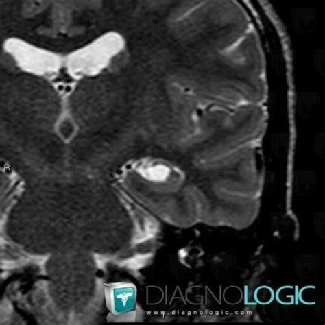 Radiology case : Choroidal fissure cyst (MRI) - Diagnologic