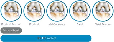 Bridge-Enhanced ACL Repair (BEAR®) Surgery for Anterior Cruciate Ligament (ACL) Regeneration ...