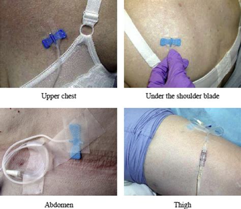 A Prospective Study of Hypodermoclysis Performed by Caregivers in the Home Setting - Journal of ...