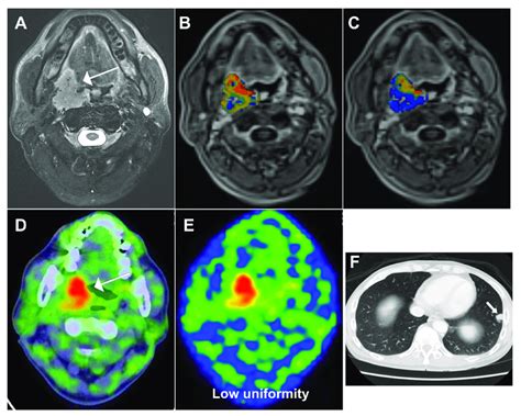 A 51-year-old male patient with oropharyngeal squamous cell carcinoma... | Download Scientific ...