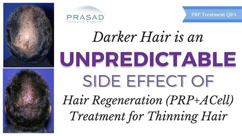 Prp Hair Treatment Side Effects - Doctor Heck