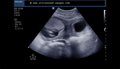 cochinblogs: Ultrasound- subseptate uterus with pregnancy