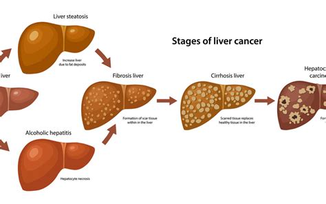 Liver Cancer Types And Stages