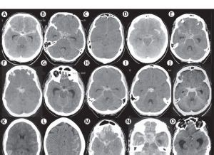 Three Signs Your Bad Headache Might Be a Ruptured Brain Aneurysm - Brain Aneurysm Foundation